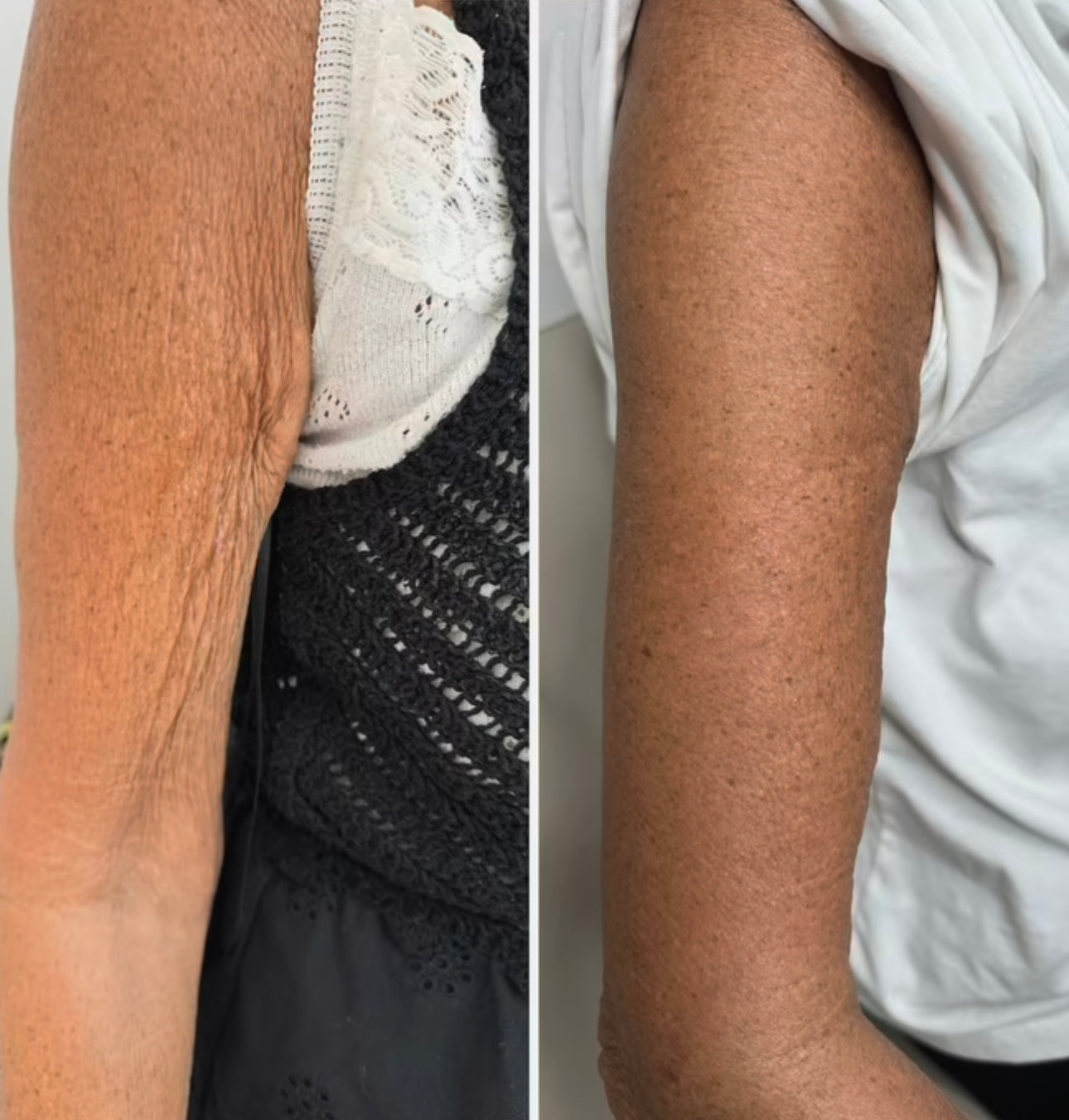Mesotherapie RH KOLLAGEN (Hautalterung dramatisch regeneriert, verjüngt)