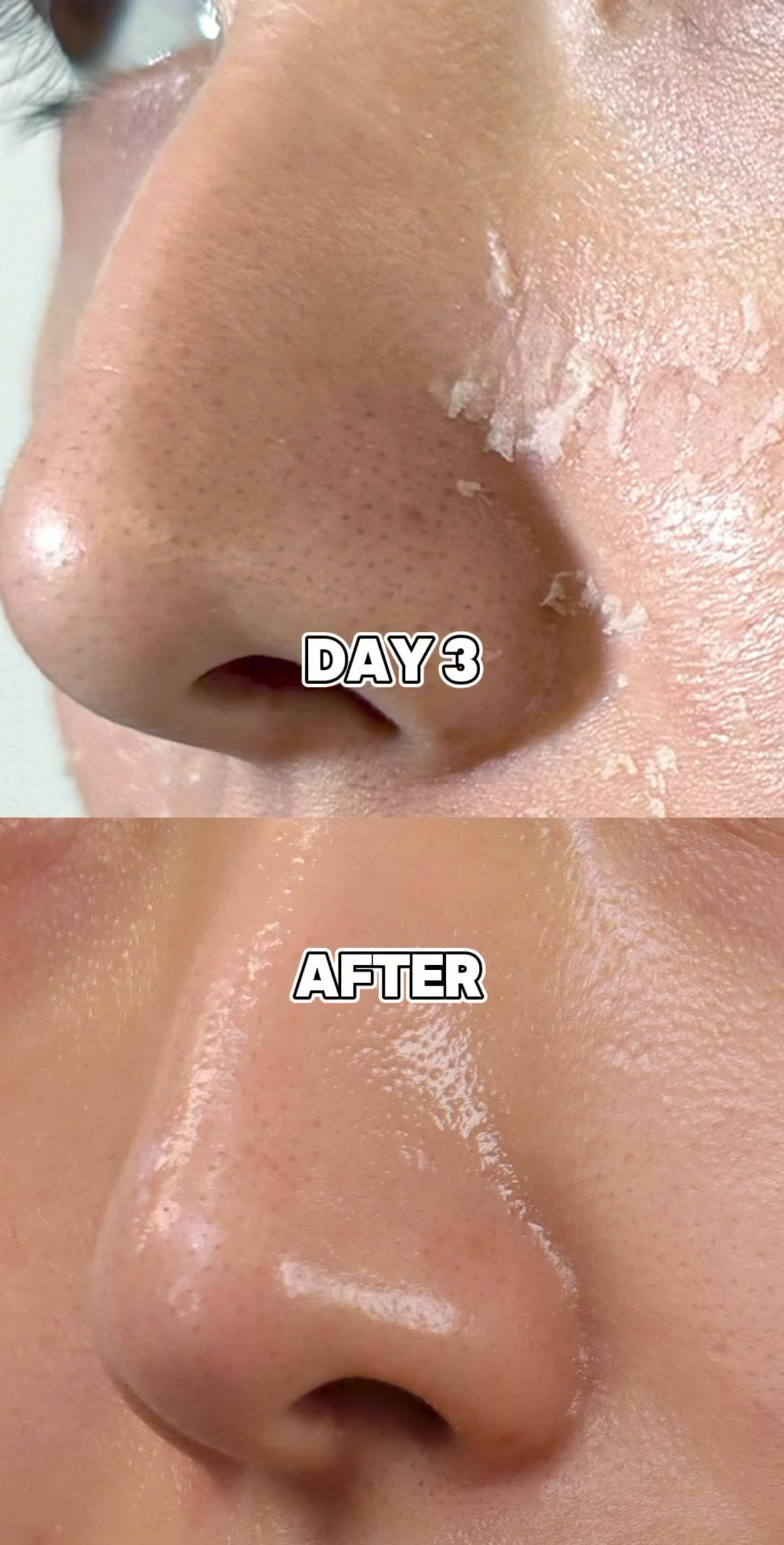 Medisco Peelings S-Deep Peel-Programm + inklusive Heimpflegeprodukten