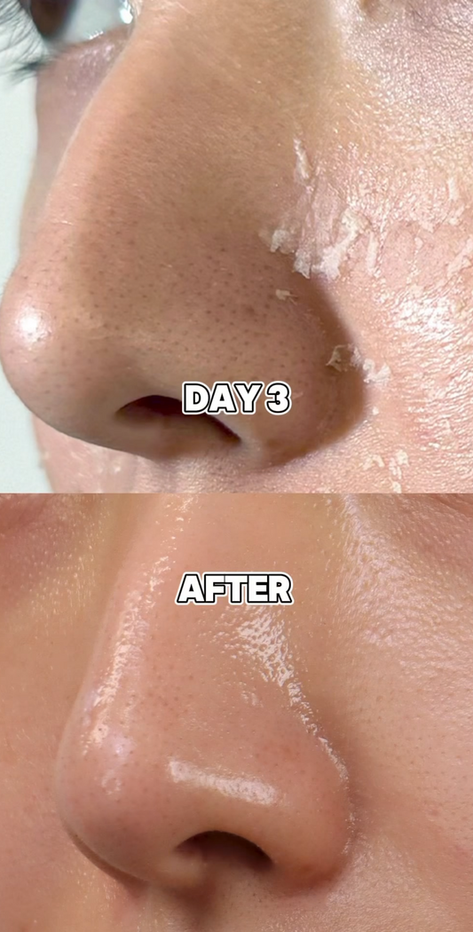 Chemische Peelings S-Light Peel-Programm + inklusive Heimpflegeprodukten