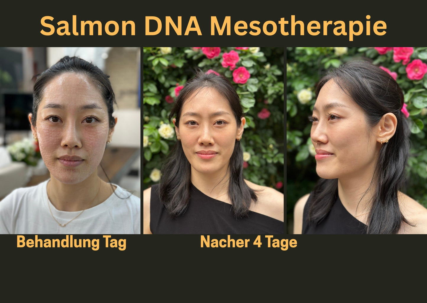 Mesotherapie Anti -Aging + Lifting Lachs-DNA Skinbooster
