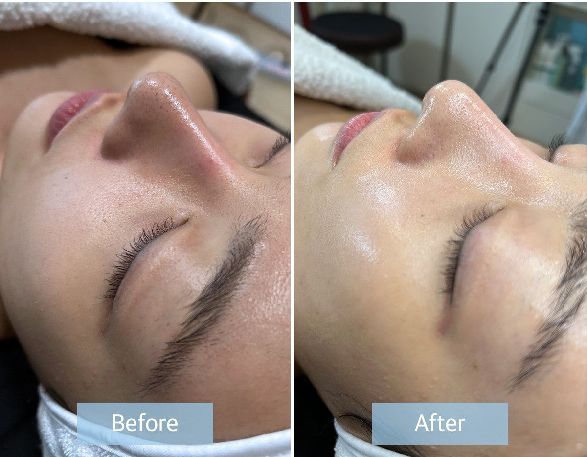 Microneedling Whitening stem cell Cultur