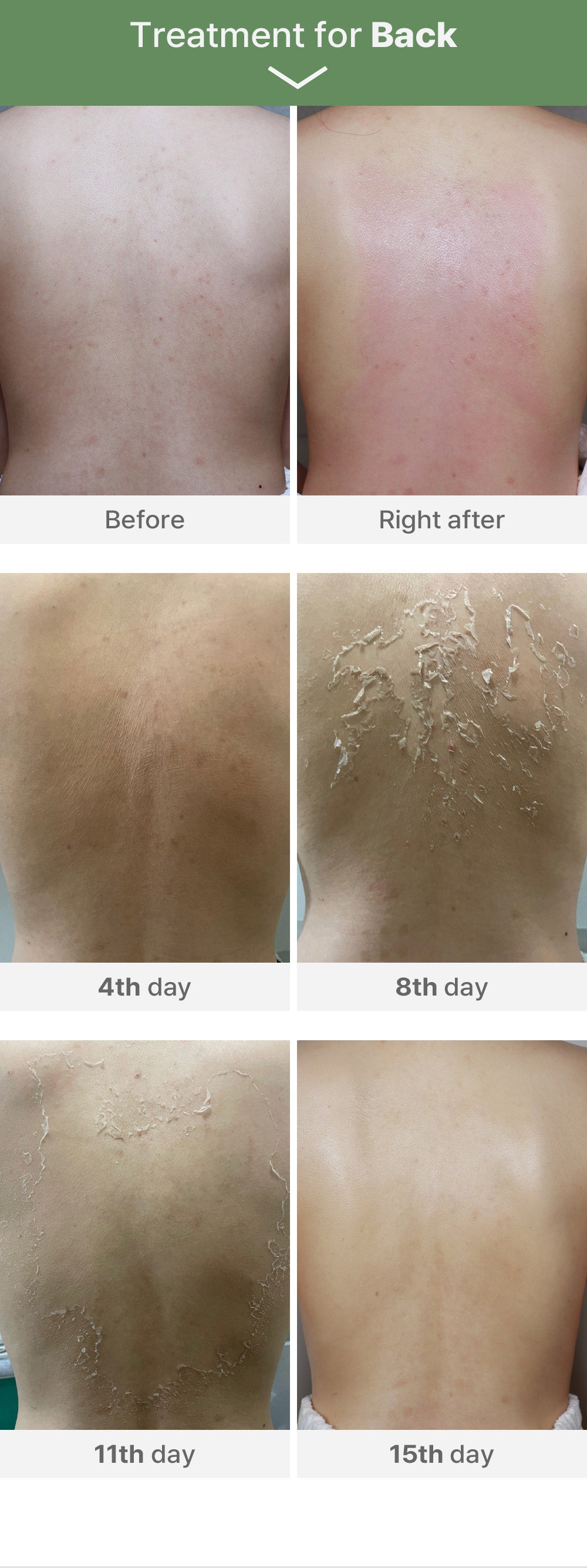 Medisco Peelings S-Deep Peel-Programm + inklusive Heimpflegeprodukten