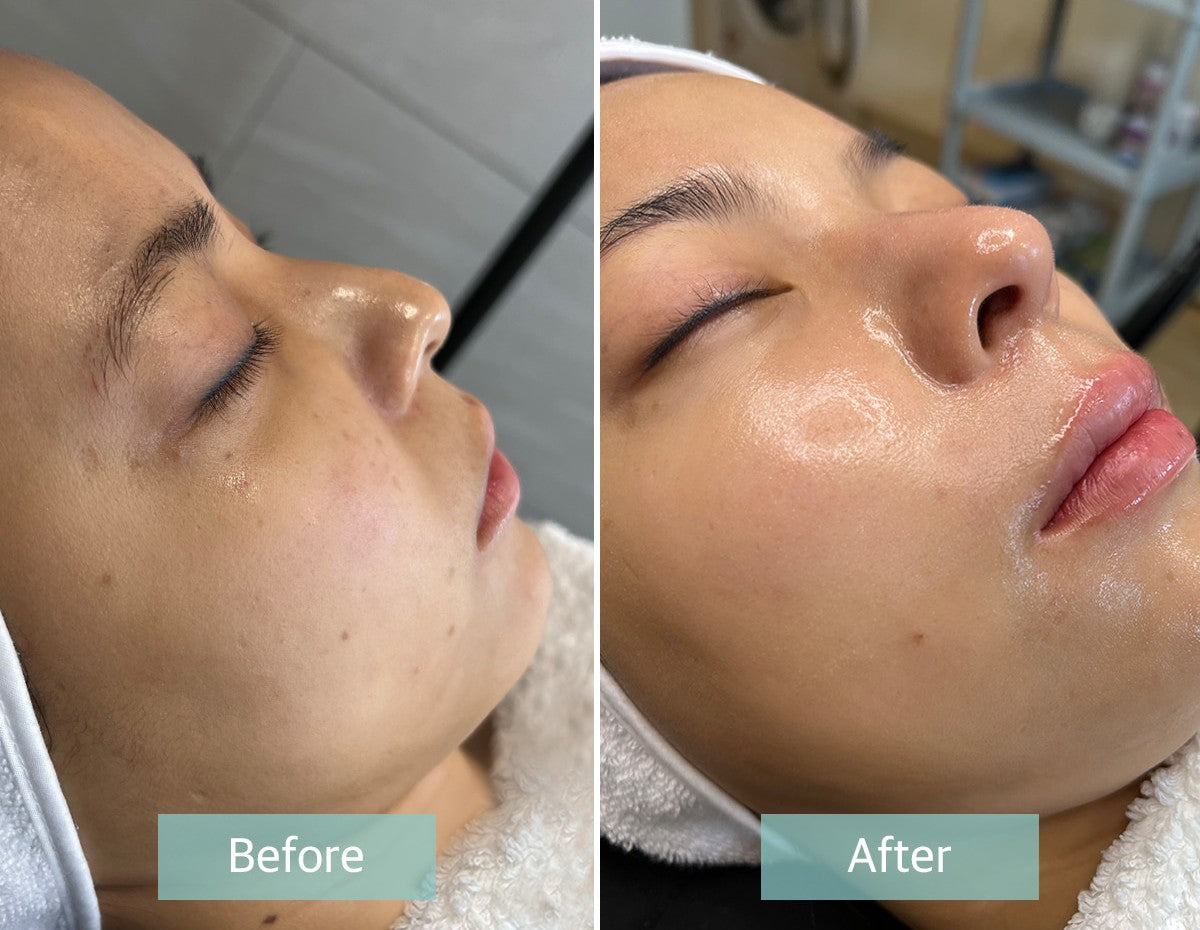 Microneedling AC Stem Cell Gold Cultur