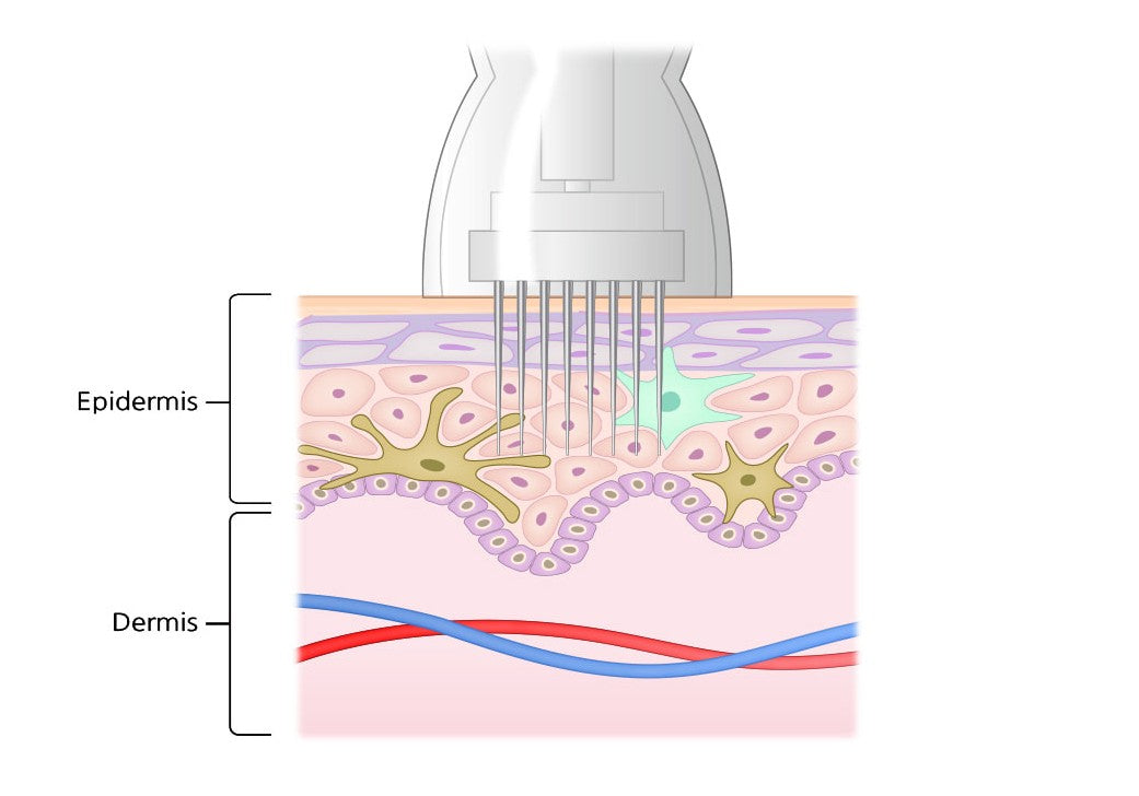 Microneedling Aqua stem cell
