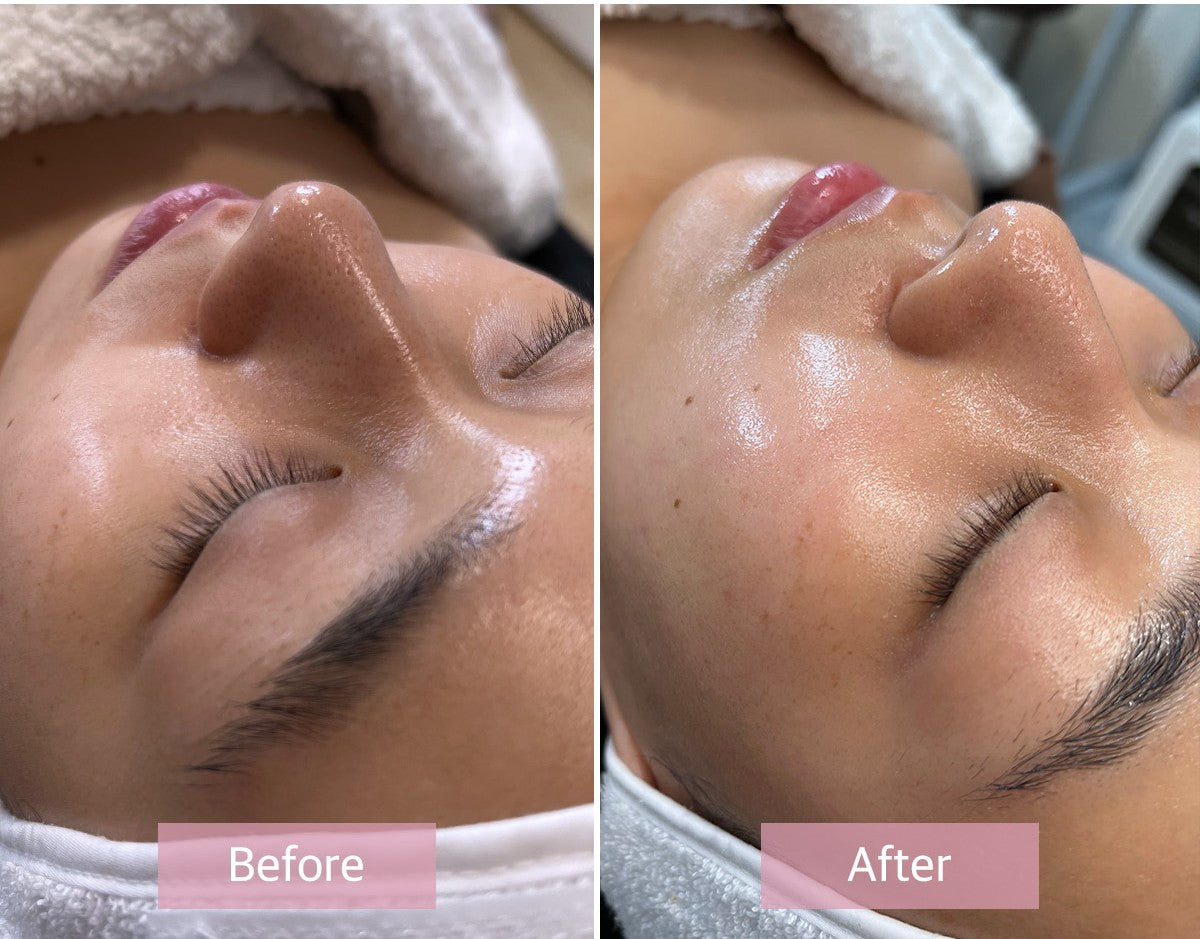 Microneedling Aqua stem cell
