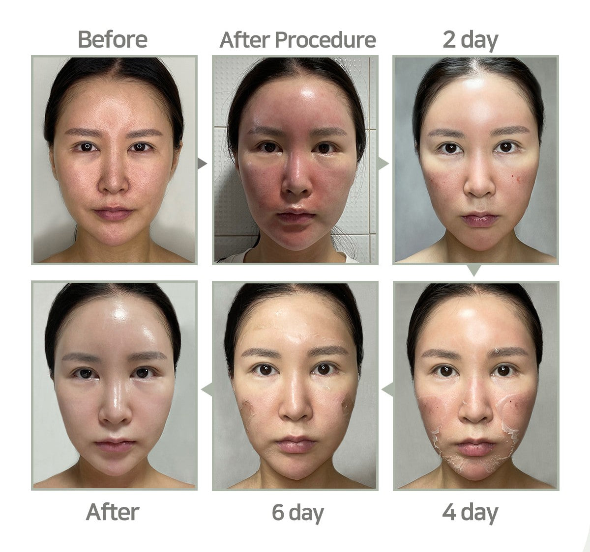 Medisco Peelings S-Deep Peel-Programm + inklusive Heimpflegeprodukten