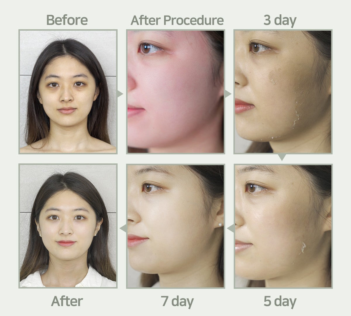 Chemische Peelings S-Light Peel-Programm + inklusive Heimpflegeprodukten