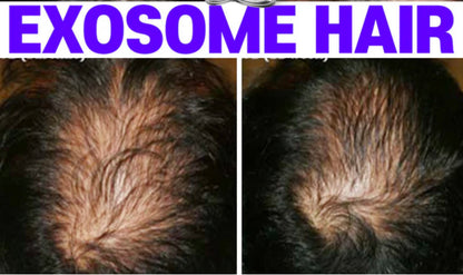 Microneedling Exosom Haar Booster